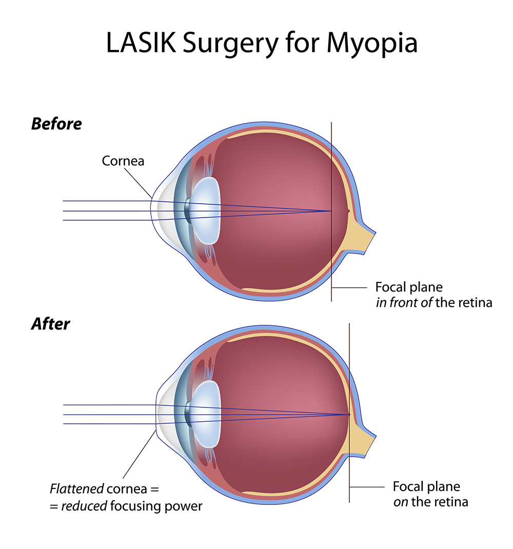 The Shape Of Your Eye And Your Vision